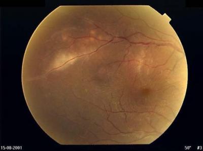 FIGURE 1:	Case 1. Fundus photograph of the right eye showing phlebitis of the superotemporal vein with three adjacent choroidal lesions with macular oedema and disc hyperaemia.